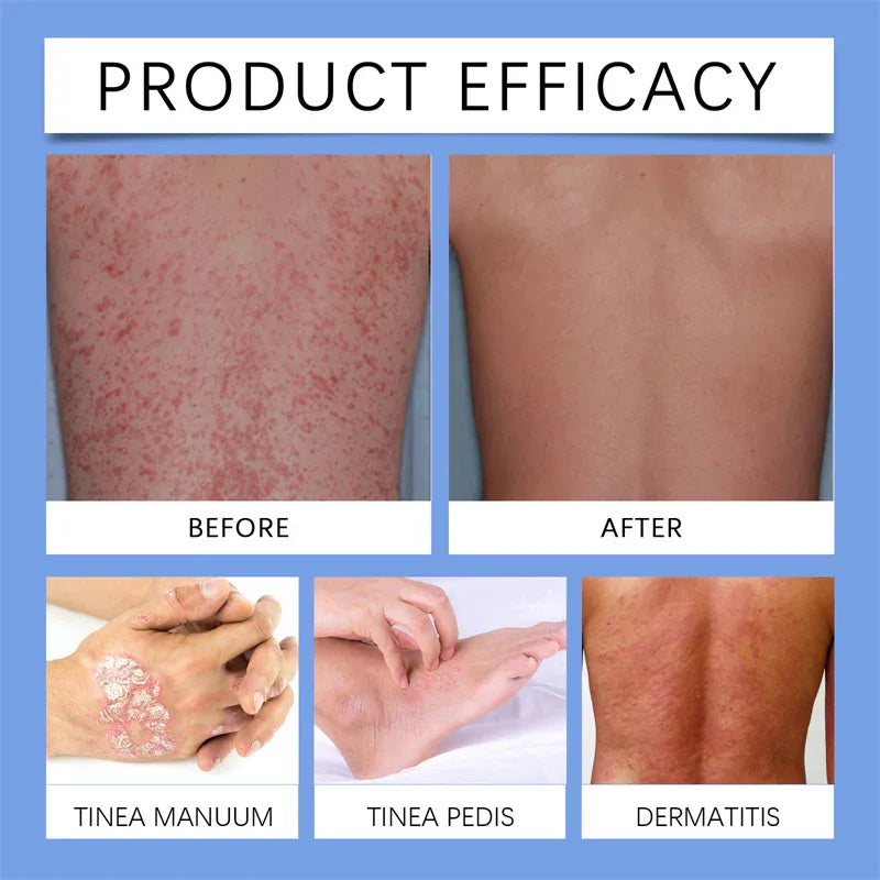 Spray para la psoriasis de la piel