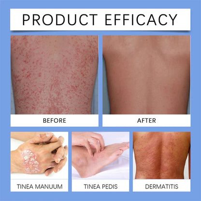 Spray para la psoriasis de la piel